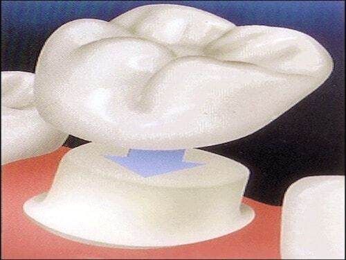 Porcelain_Veneers_Bridges_Crowns_Newmarket