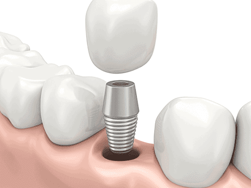 implants